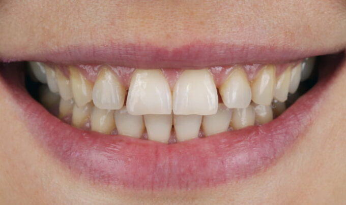 Before - Cavendish Dental Care